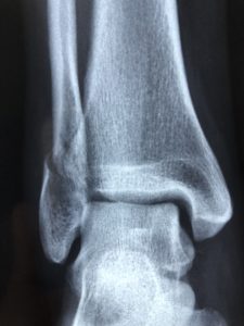 Sprained Ankle RSD